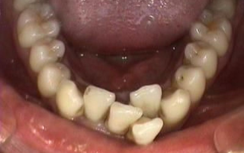 KETAHUI PENYEBAB GIGI BERLUBANG DAN CARA MENGATASINYA